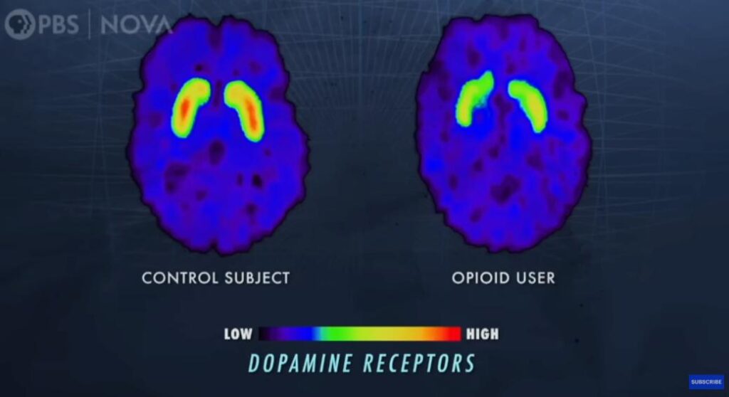Addiction: The Science Behind (NOVA PBS) 1 Brain scans highlighting the activation of dopamine receptors in a control subject versus an opioid use